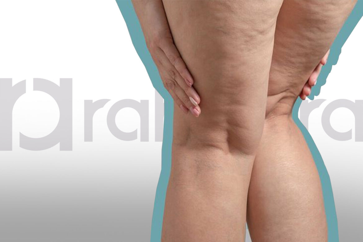 permanent treatment for cellulite in Iran