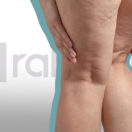 permanent treatment for cellulite in Iran