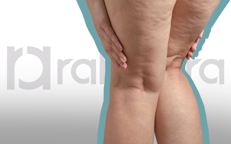 permanent treatment for cellulite in Iran