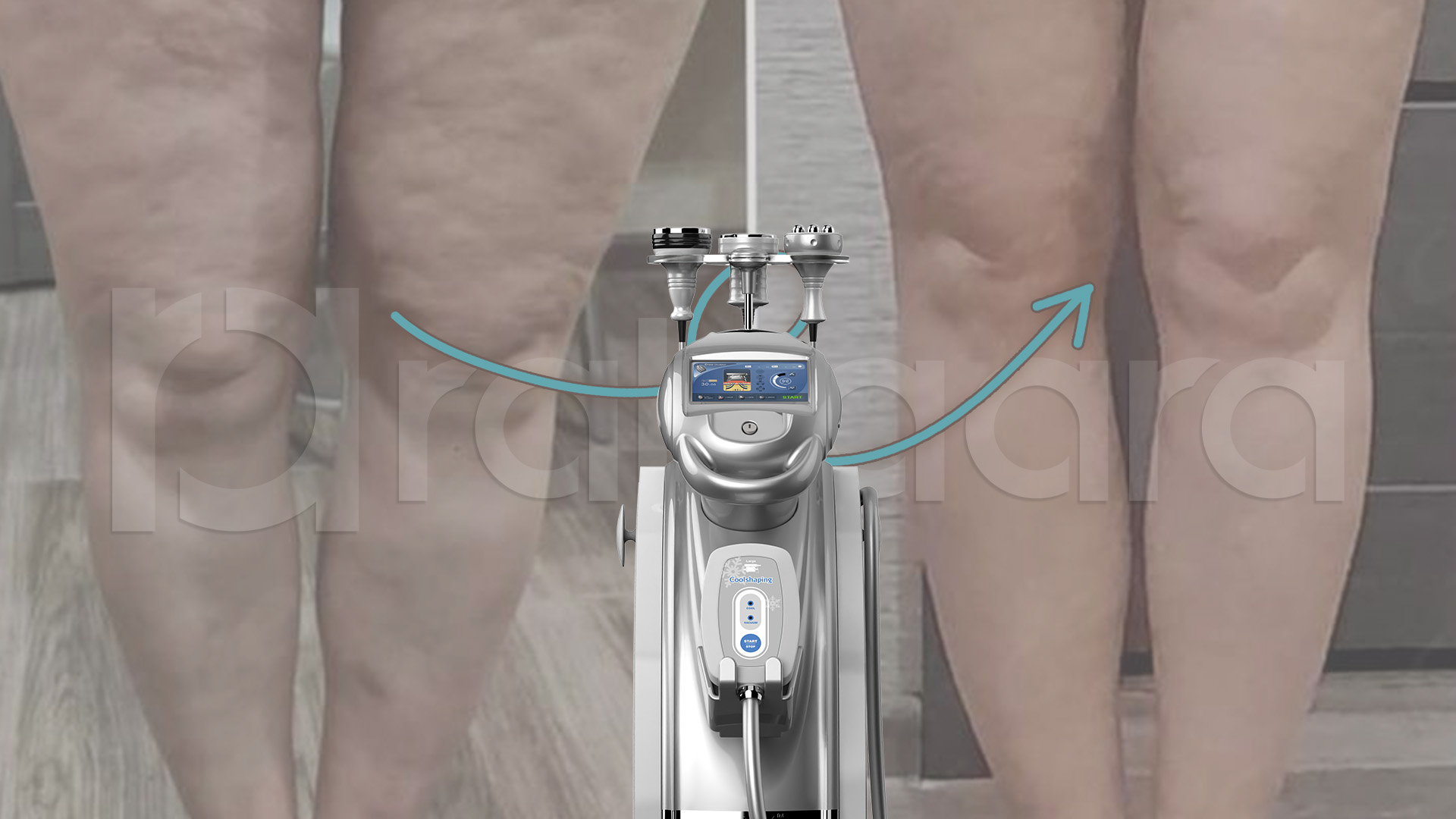 cellulite treatment machines in Iran